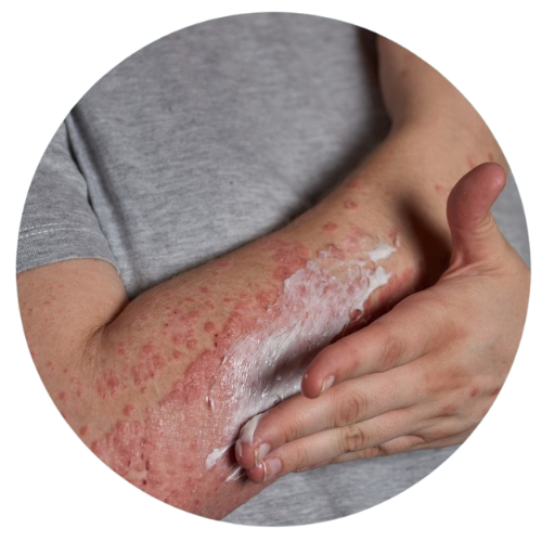 POMMADES PSORIASIS